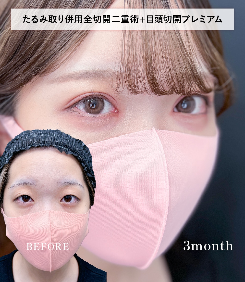 全切開二重術+目頭切開プレミアム