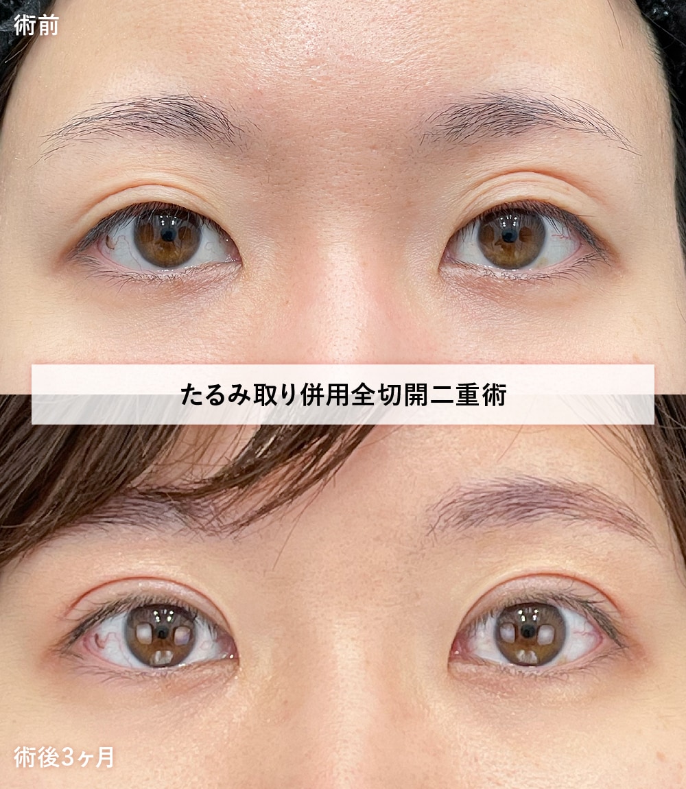 全切開二重術