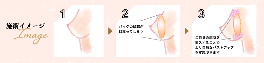 『ハイブリッド豊胸』<br />
長所を組み合わせた最高の豊胸術