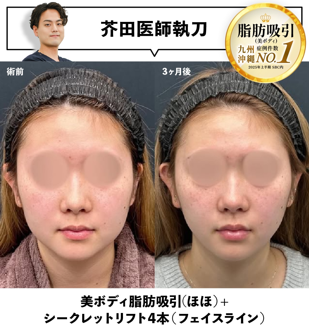 脂肪吸引+糸リフト