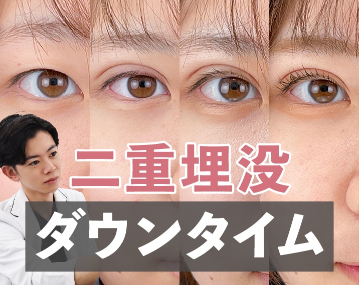 【二重埋没法】ダウンタイムはほぼナシ？仕事や学校を休めないあなたへ