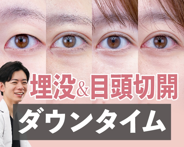 【熊本】二重埋没＋目頭切開のダウンタイムって？直後から3ヶ月まで経過を大公開！