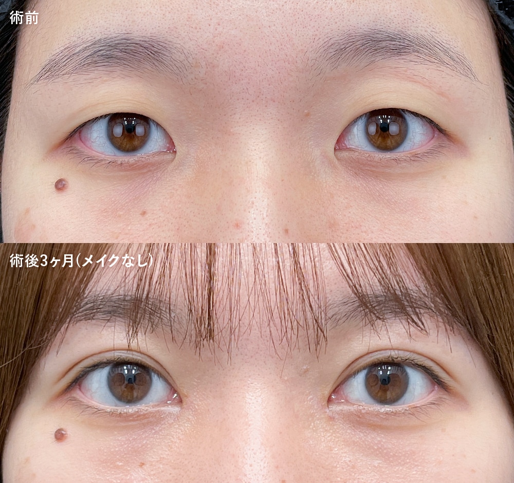 術前・3ヶ月後の比較