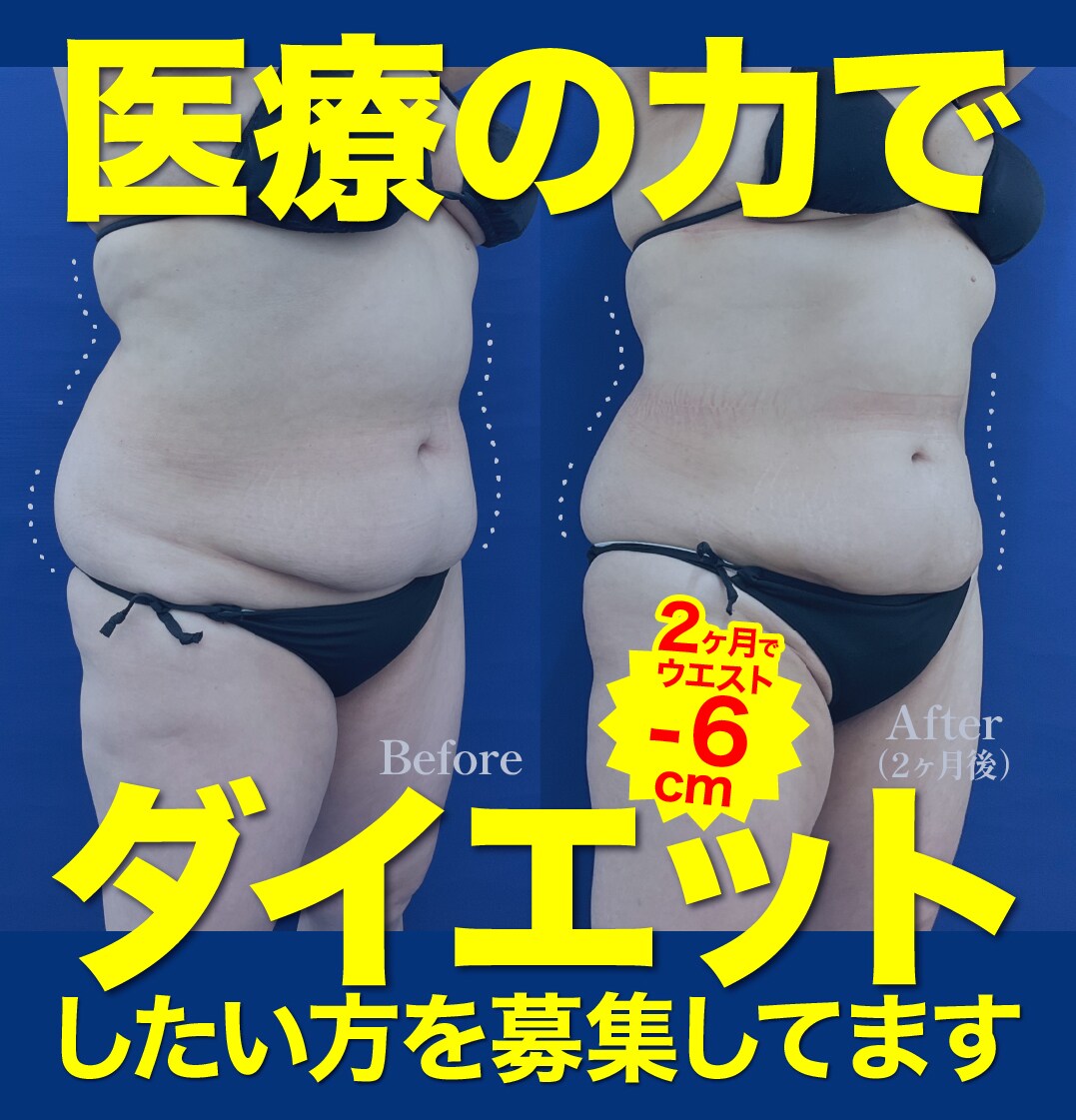 【熊本 医療ダイエット】医師の診断で楽やせ！湘南美容クリニック熊本院の切らない医療痩身特集