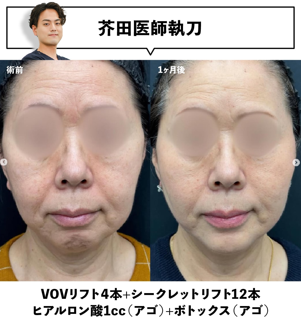 糸リフト