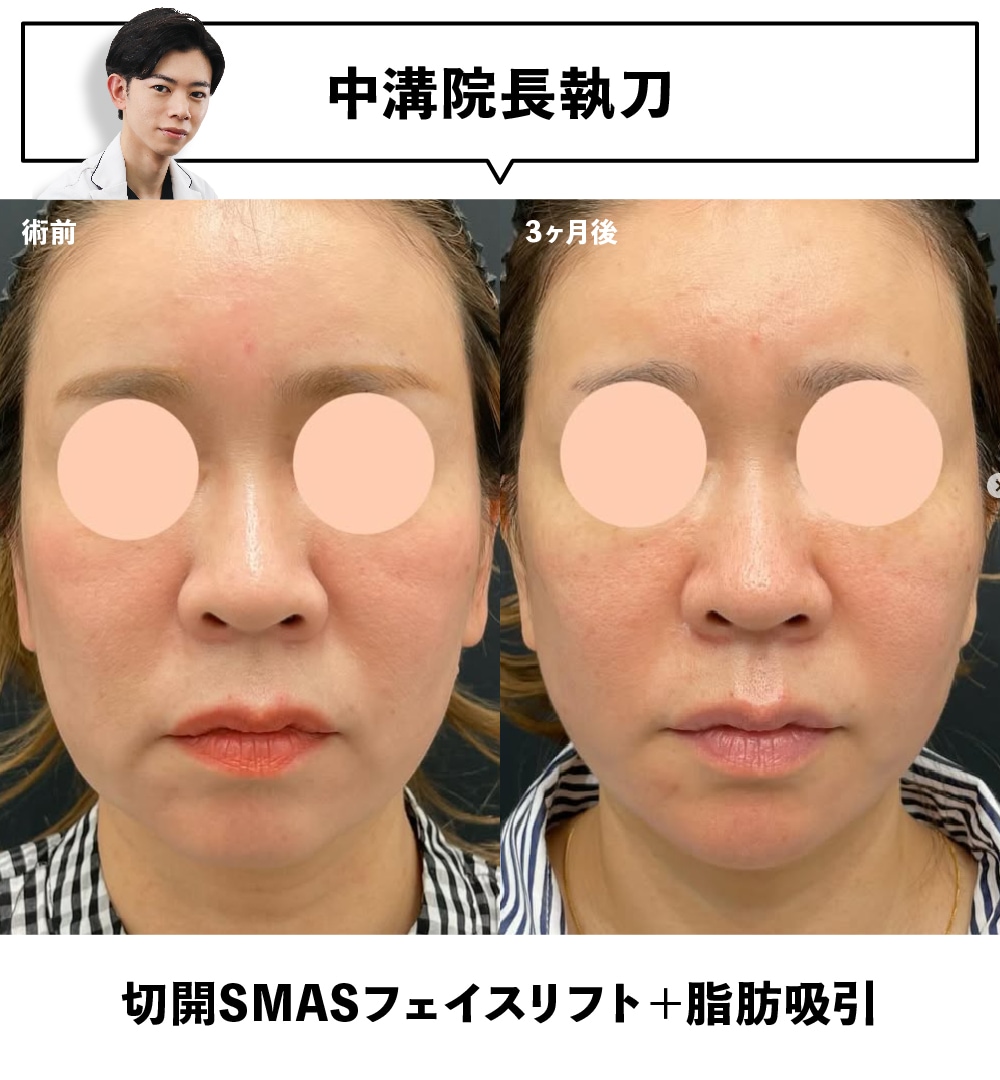 フェイスリフト（切開リフト）