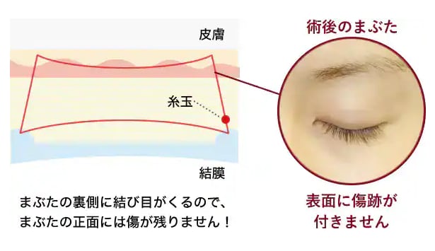 理由①:まぶたの「裏側」からアプローチ!