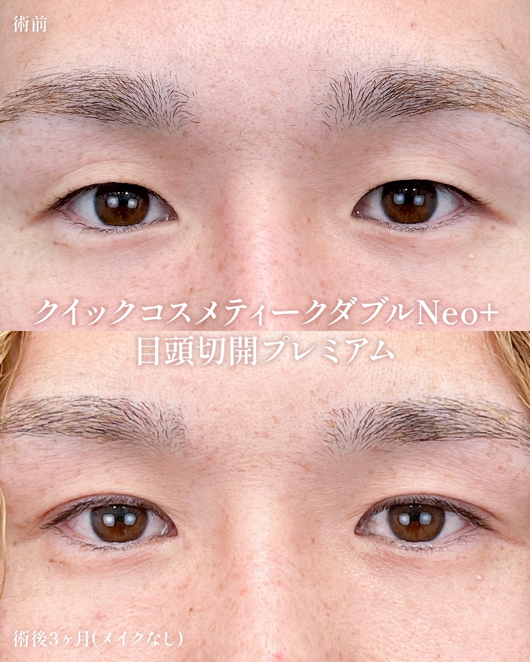 クイックコスメティークダブルNeo+目頭切開プレミアム