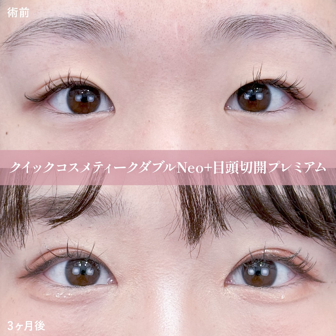 クイックコスメティークダブルNeo+目頭切開プレミアム