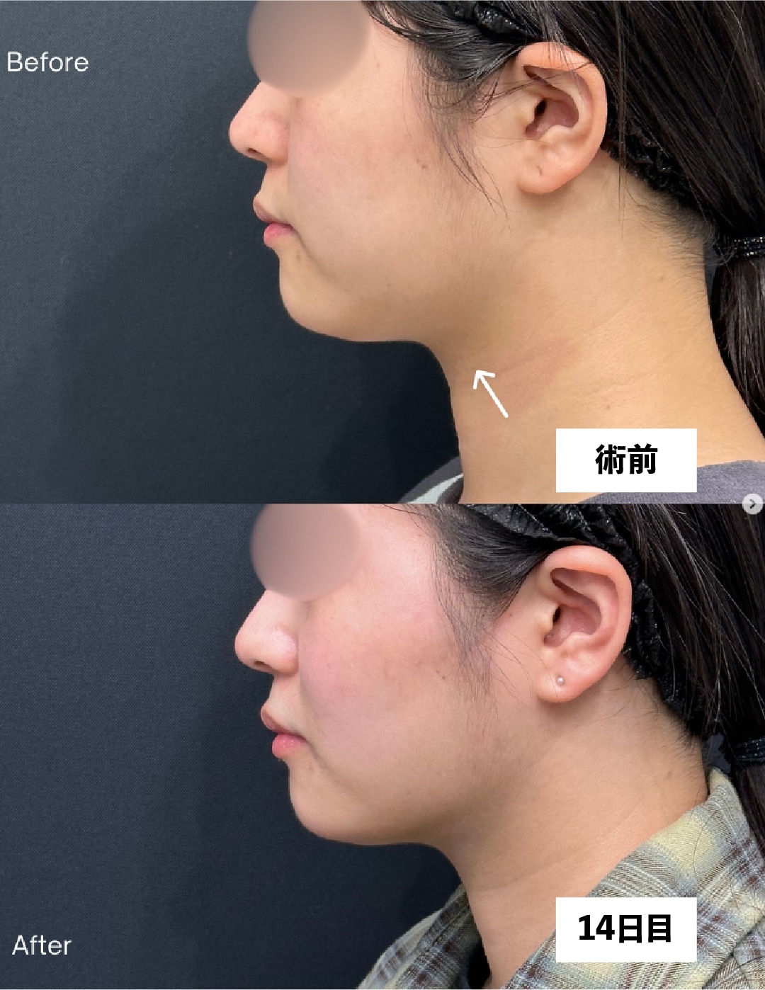 術前→2週間後