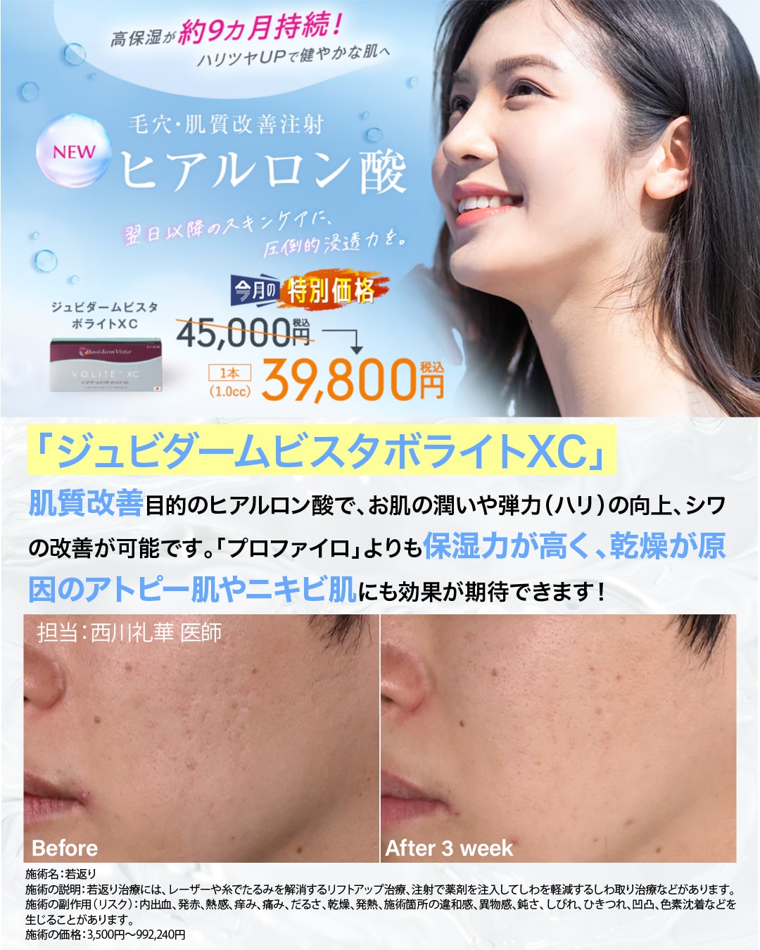 《11月限定特別価格》ヒアルロン酸（ジュビダームビスタボライトXC）