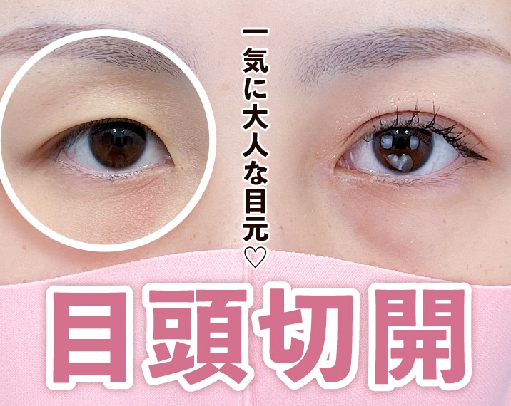 湘南美容クリニック熊本院の目頭切開で離れ目改善！