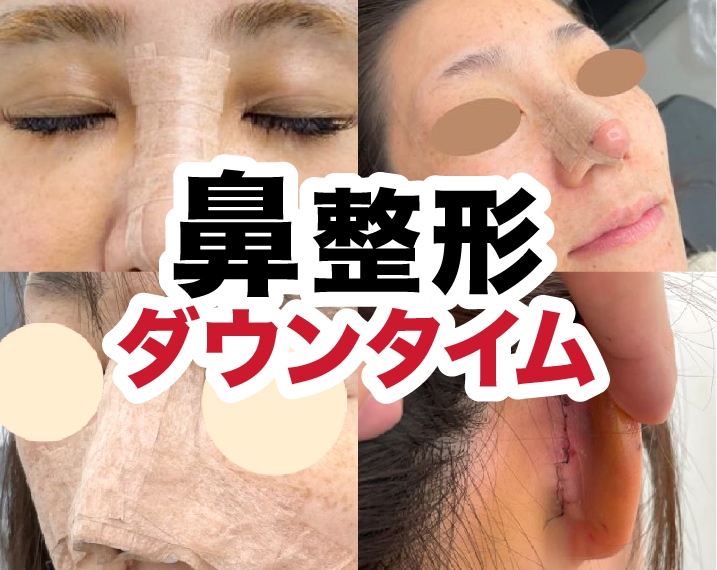 【鼻整形】施術ごとのダウンタイムをご紹介