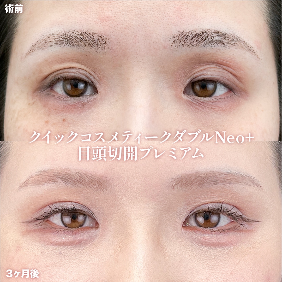 クイックコスメティークダブルNeo+目頭切開プレミアム