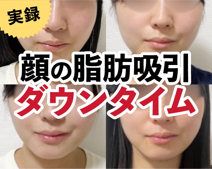 【熊本】顔の脂肪吸引注射、ダウンタイムはどれくらい？術後1日目〜14日目を写真で全公開！
