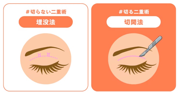 埋没法：メスを使わない選択