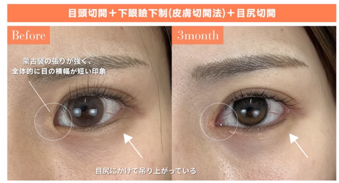 目頭切開プレミアム