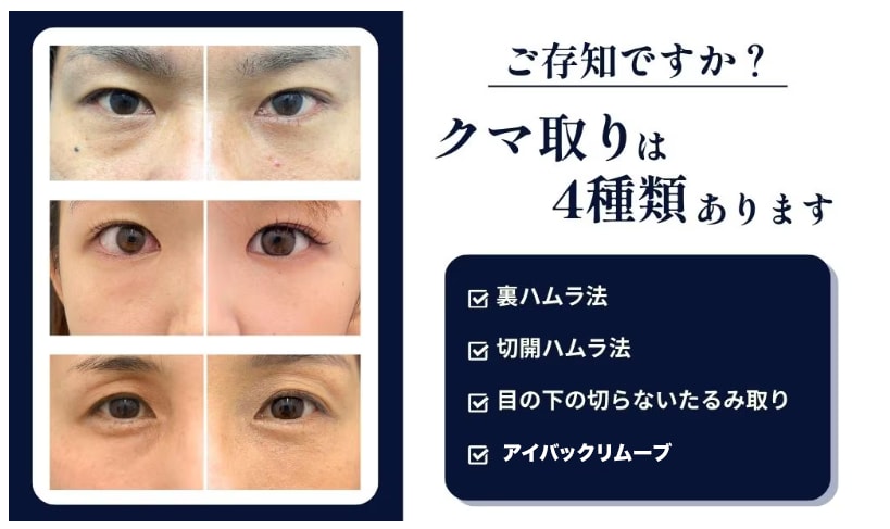 あなたの目元に合わせた「クマ治療4選」