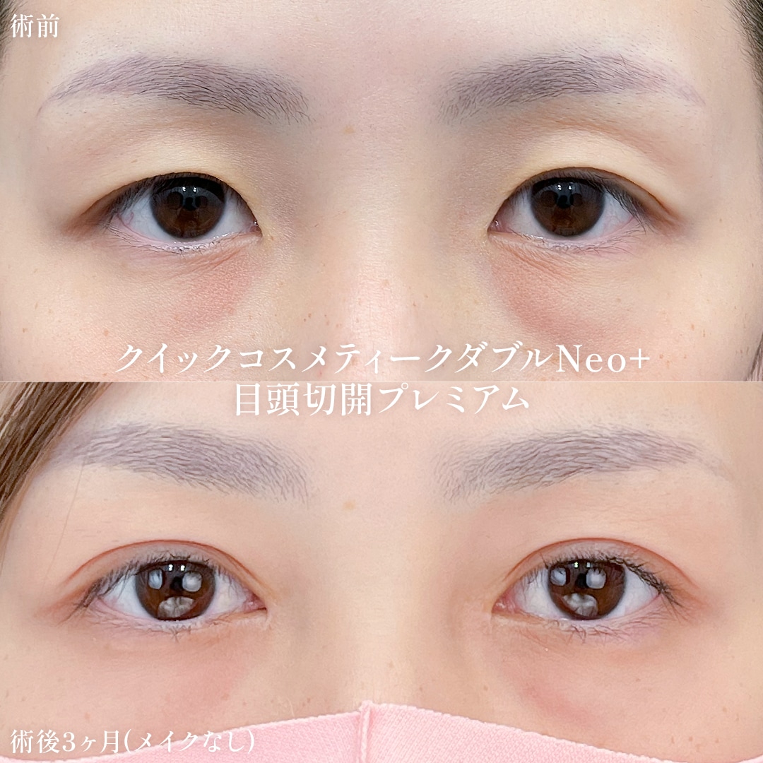 クイックコスメティークダブルNeo+目頭切開プレミアム