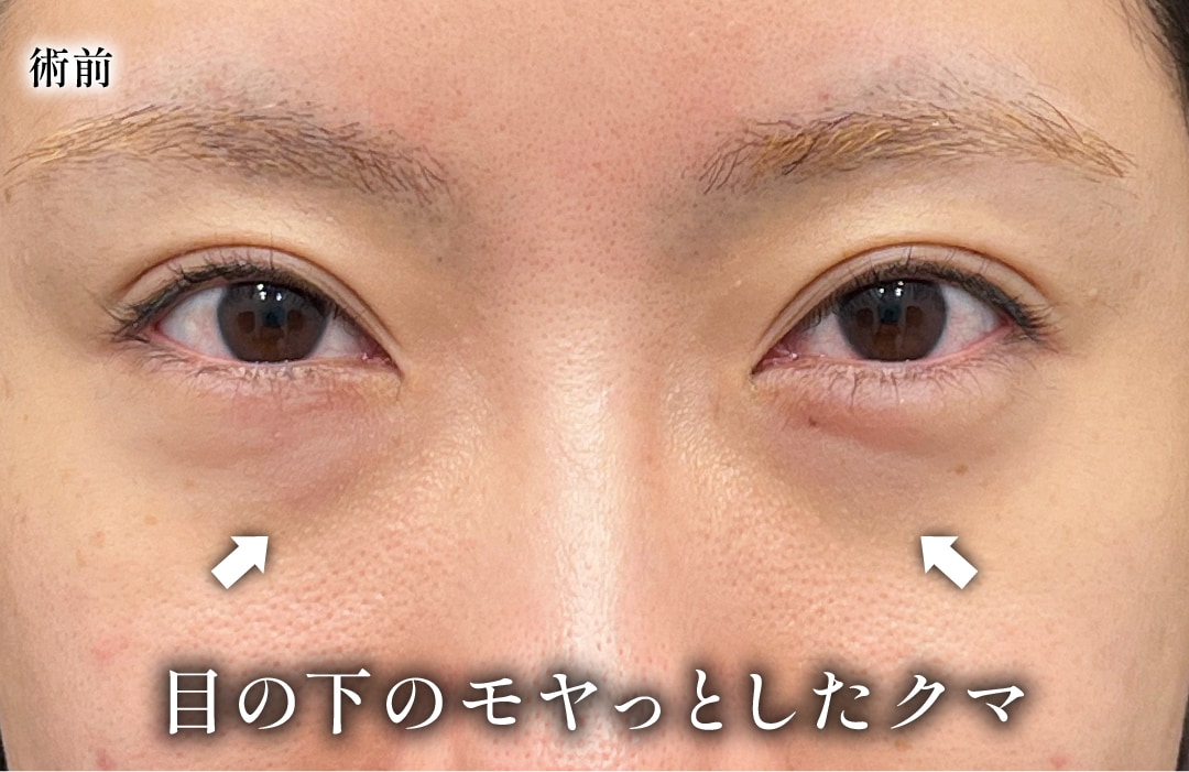 スタッフが体験！裏ハムラ法