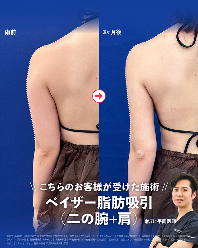 ベイザー脂肪吸引（二の腕+肩）
