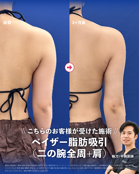 ベイザー脂肪吸引（二の腕全周+肩）