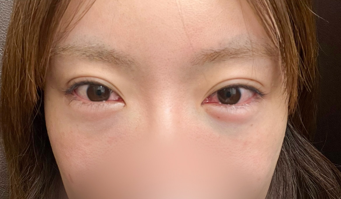 手術が終わった直後