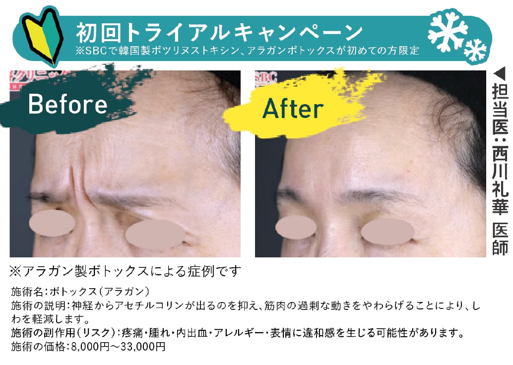 pickup：眉間ボトックス