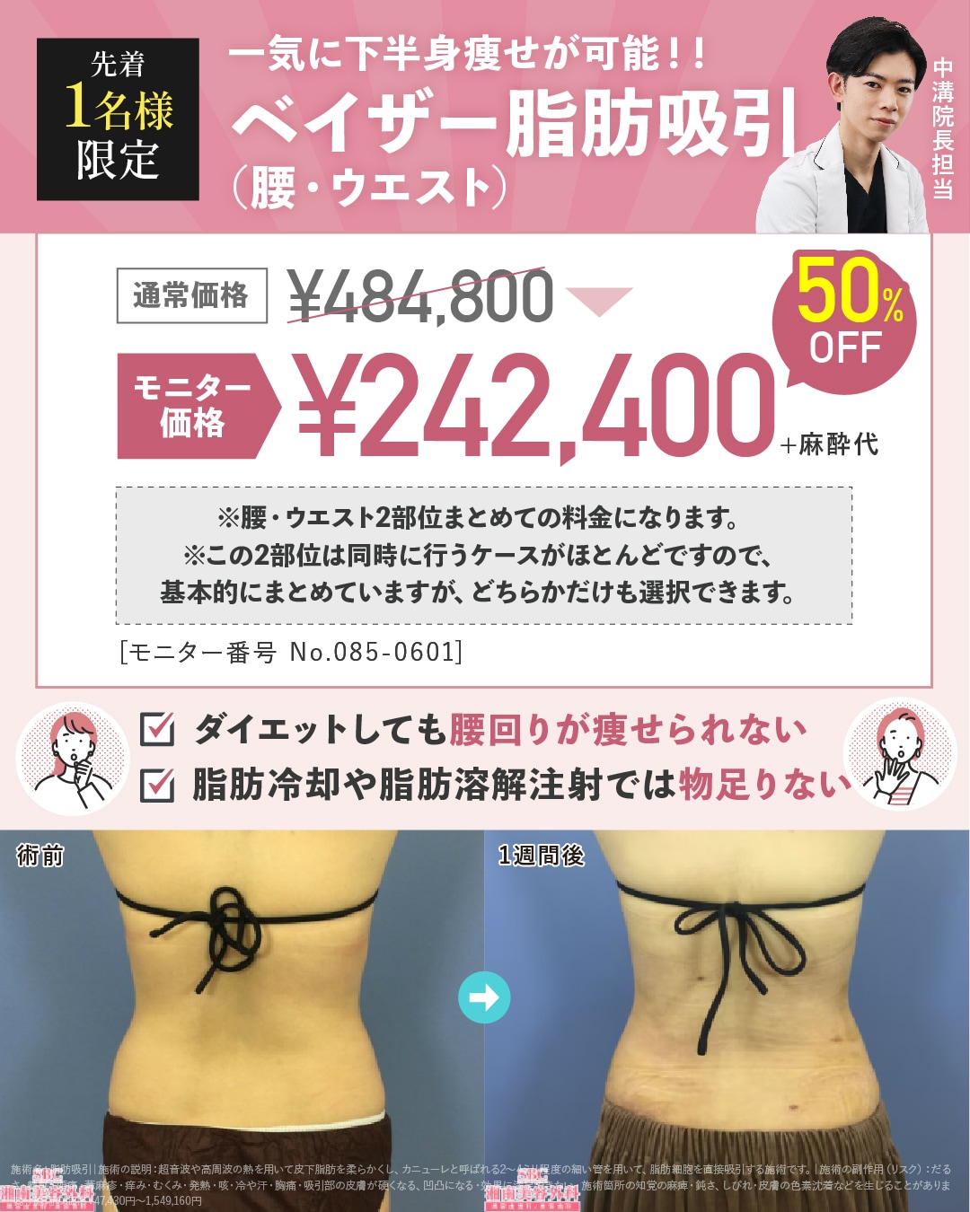 ベイザー脂肪吸引