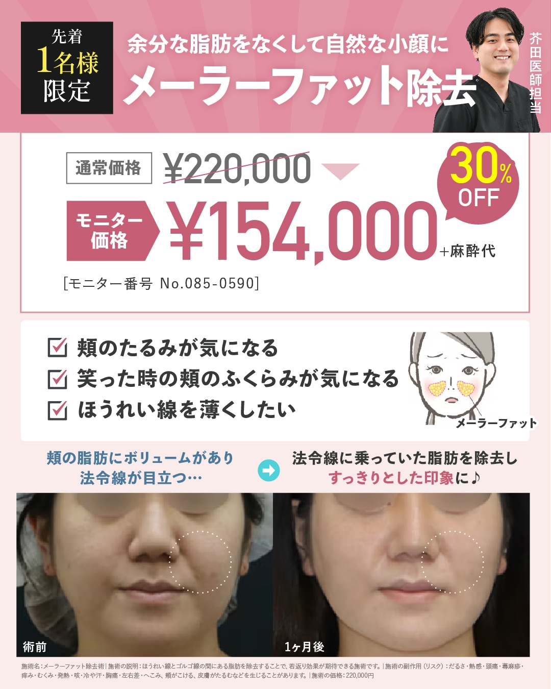 メーラーファット除去