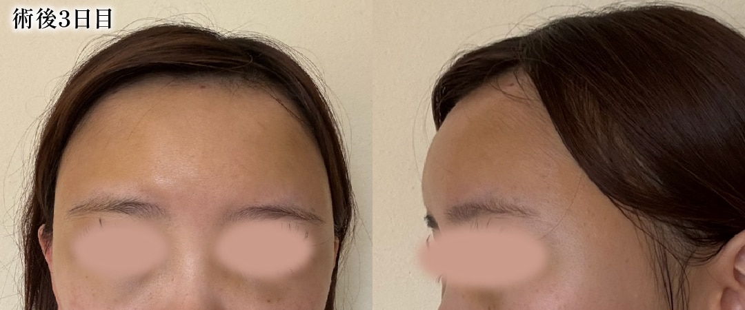 【術後3日目】