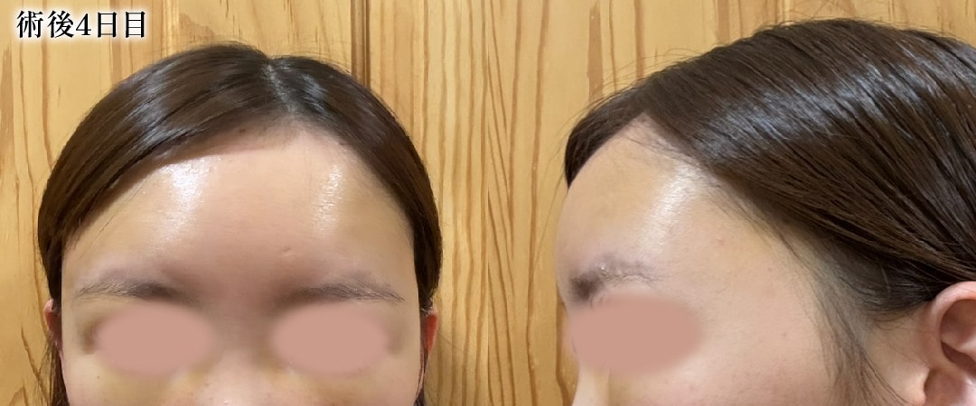 【術後4日目】