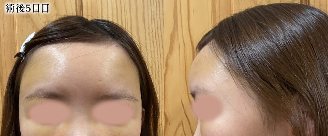 【術後5日目】