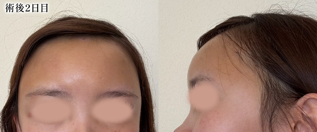 【術後2日目】