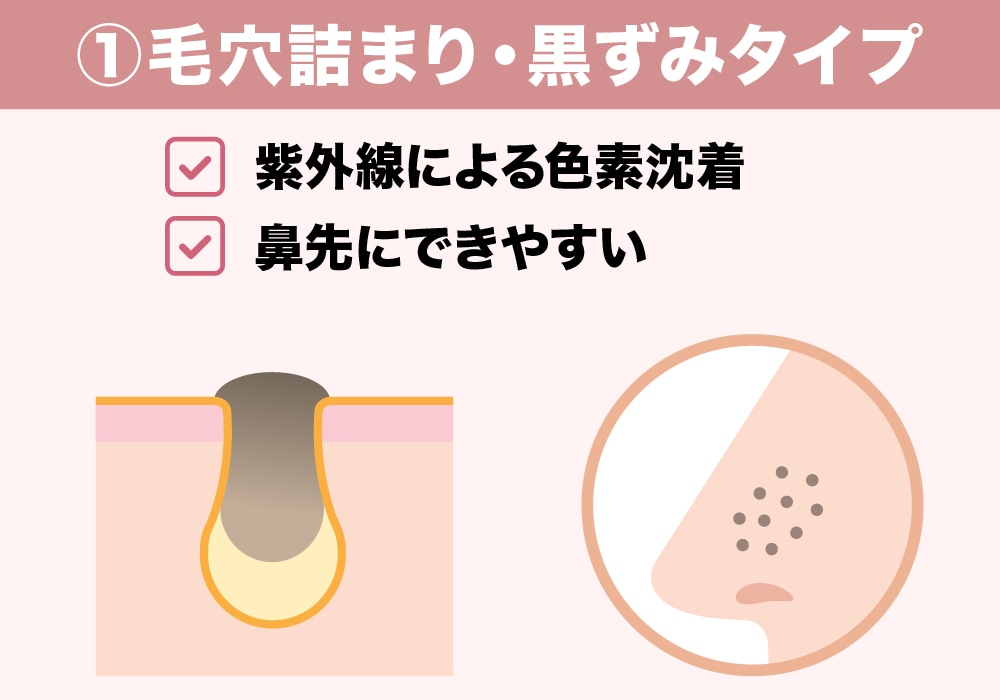 ①毛穴詰まり・黒ずみタイプ