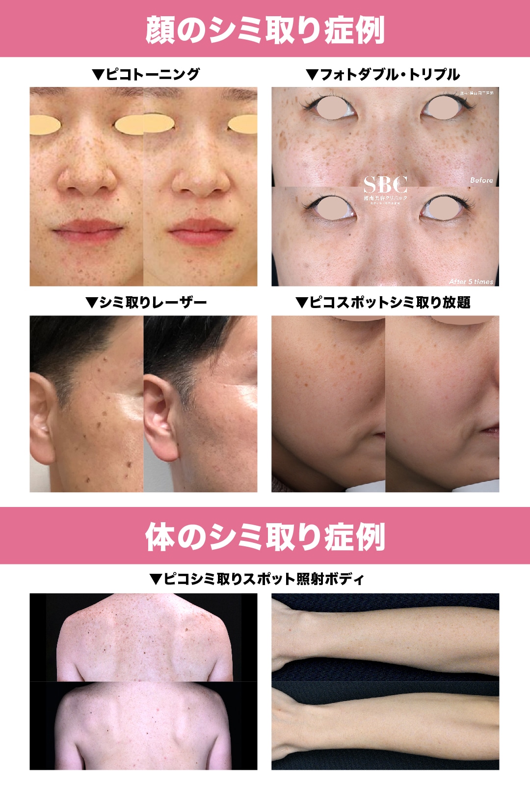 湘南美容クリニックのシミ取り