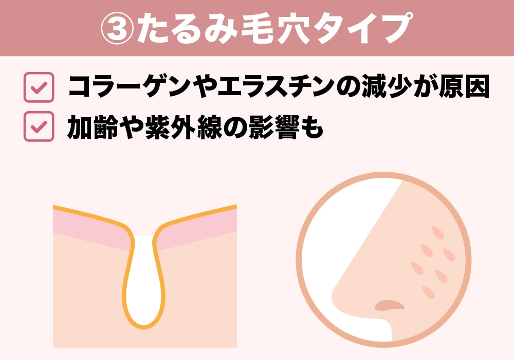 ③たるみ毛穴タイプ