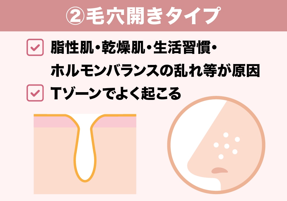 ②毛穴開きタイプ