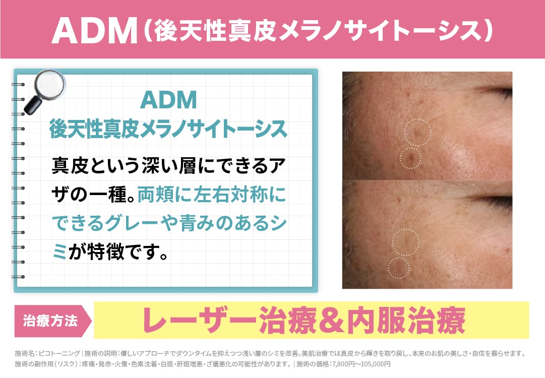 【ADM（後天性真皮メラノサイトーシス）】<br />
