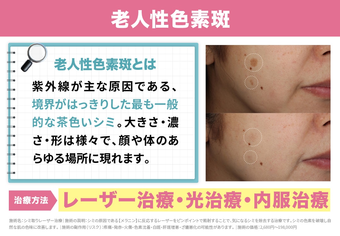 【老人性色素斑】<br />

