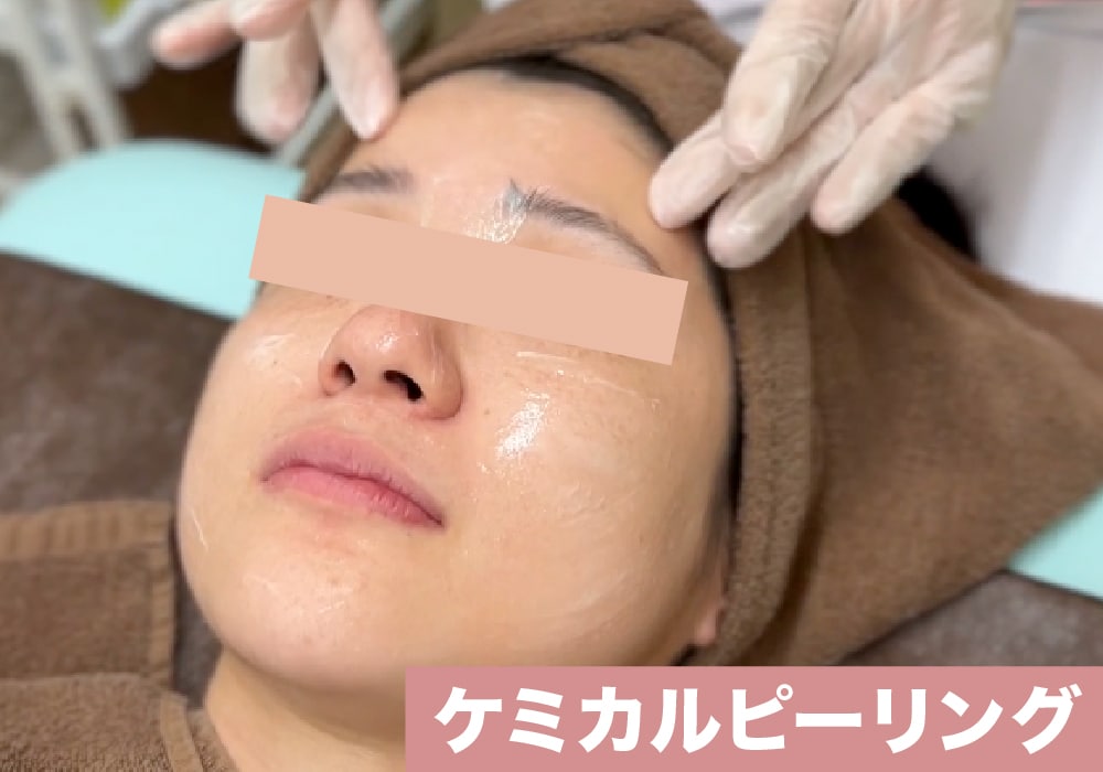 ケミカルピーリング（サリチル酸マクロゴール）