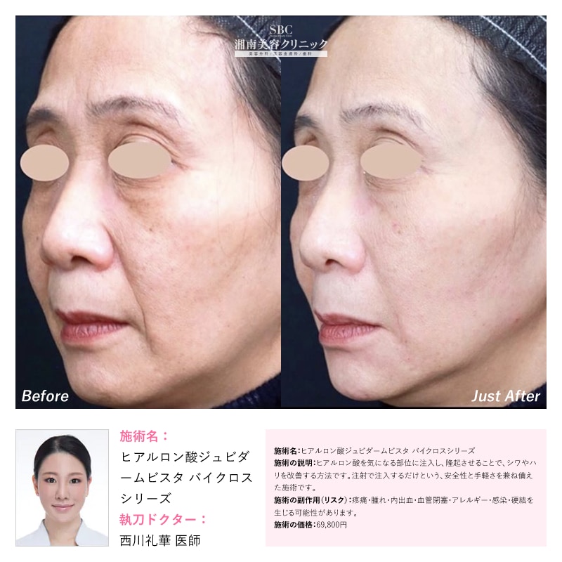 ヒアルロン酸ジュビダームビスタ バイクロスシリーズ