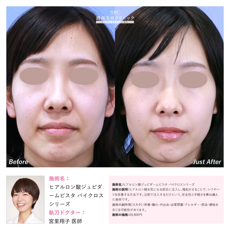 ヒアルロン酸ジュビダームビスタ バイクロスシリーズ