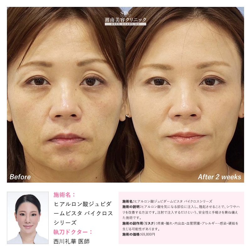 ヒアルロン酸ジュビダームビスタ バイクロスシリーズ