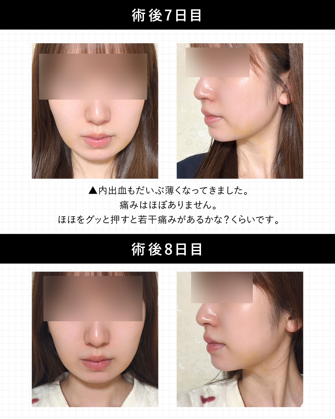 術後 7・8日目