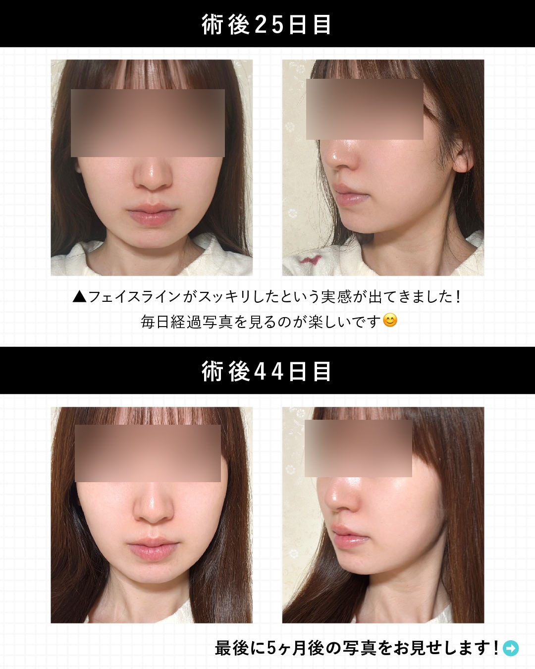 術後 25・44日目