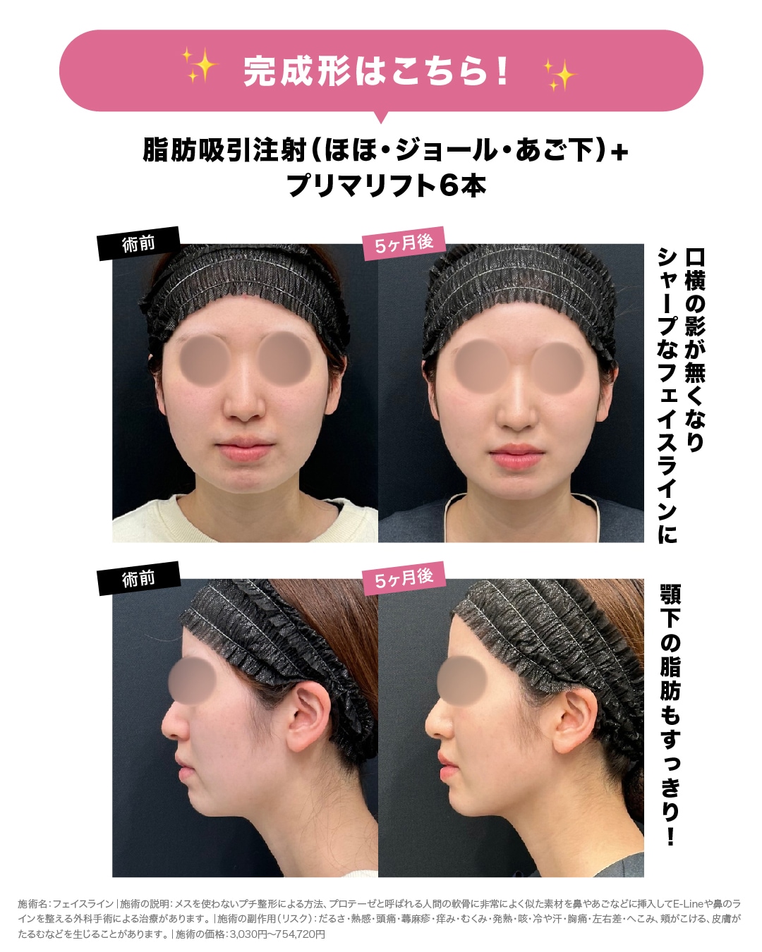 術前→5ヶ月後
