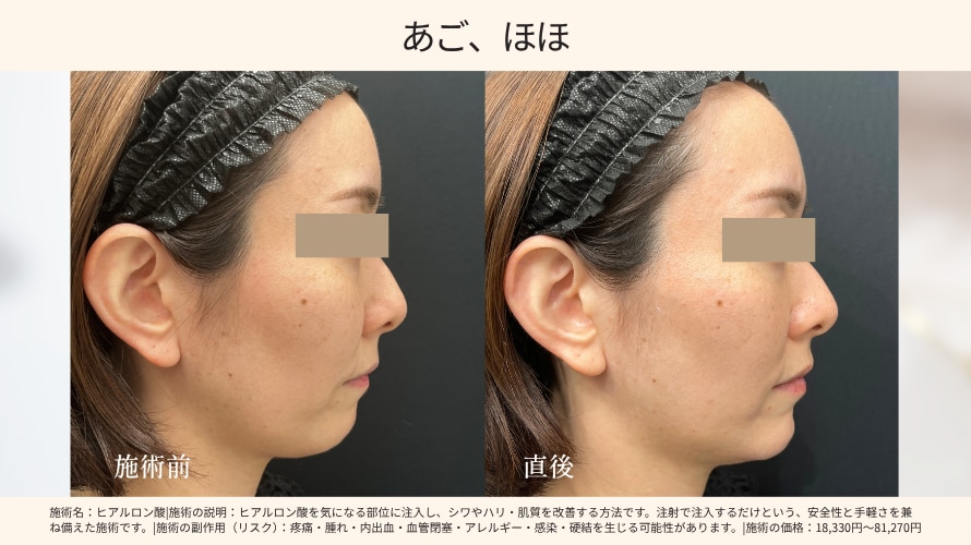 あご、頬