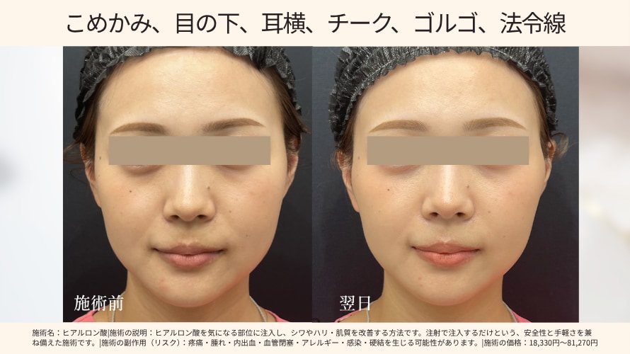 こめかみ、目の下、耳横、チーク、ゴルゴ、法令線