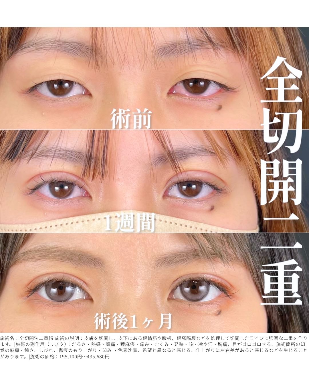 全切開二重術
